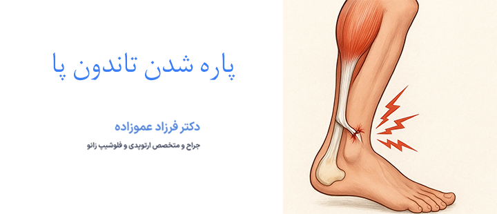 پاره شدن تاندون پا چه علائمی دارد؟